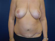 Breast Lift After Photo by Michael Dobryansky, MD, FACS; Garden City, NY - Case 29101