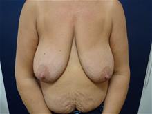 Breast Lift Before Photo by Michael Dobryansky, MD, FACS; Garden City, NY - Case 29101