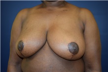 Breast Reduction After Photo by Michael Dobryansky, MD, FACS; Garden City, NY - Case 30291