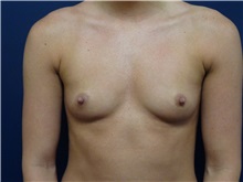 Breast Augmentation Before Photo by Michael Dobryansky, MD, FACS; Garden City, NY - Case 30293