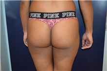 Buttock Lift with Augmentation Before Photo by Michael Dobryansky, MD, FACS; Garden City, NY - Case 30296