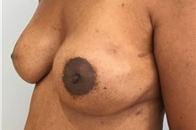 Breast Reconstruction After Photo by Michael Dobryansky, MD, FACS; Garden City, NY - Case 34940