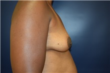 Breast Reconstruction Before Photo by Michael Dobryansky, MD, FACS; Garden City, NY - Case 34940