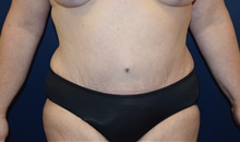 Tummy Tuck After Photo by Michael Dobryansky, MD, FACS; Garden City, NY - Case 34941