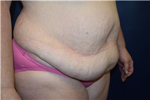 Tummy Tuck Before Photo by Michael Dobryansky, MD, FACS; Garden City, NY - Case 34941
