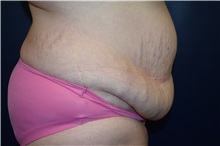Tummy Tuck Before Photo by Michael Dobryansky, MD, FACS; Garden City, NY - Case 34941