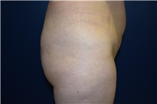 Buttock Lift with Augmentation Before Photo by Michael Dobryansky, MD, FACS; Garden City, NY - Case 34946