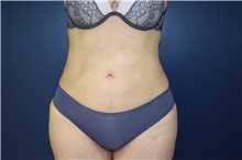 Liposuction After Photo by Michael Dobryansky, MD, FACS; Garden City, NY - Case 34947