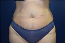 Liposuction Before Photo by Michael Dobryansky, MD, FACS; Garden City, NY - Case 34947
