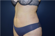 Liposuction After Photo by Michael Dobryansky, MD, FACS; Garden City, NY - Case 34947