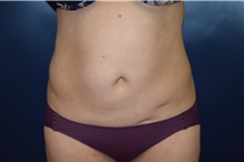 Liposuction Before Photo by Michael Dobryansky, MD, FACS; Garden City, NY - Case 34948