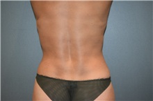 Liposuction After Photo by Michael Dobryansky, MD, FACS; Garden City, NY - Case 34948