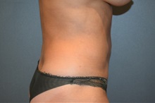 Liposuction After Photo by Michael Dobryansky, MD, FACS; Garden City, NY - Case 34948