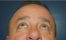 Eyelid Surgery Before Photo by Michael Dobryansky, MD, FACS; Garden City, NY - Case 34954