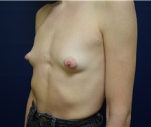 Breast Augmentation Before Photo by Michael Dobryansky, MD, FACS; Garden City, NY - Case 36749