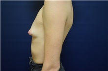 Breast Augmentation Before Photo by Michael Dobryansky, MD, FACS; Garden City, NY - Case 36749