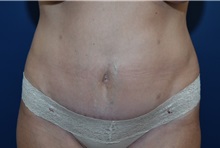 Tummy Tuck After Photo by Michael Dobryansky, MD, FACS; Garden City, NY - Case 36752