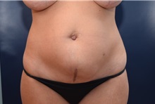 Tummy Tuck Before Photo by Michael Dobryansky, MD, FACS; Garden City, NY - Case 36752