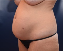 Tummy Tuck Before Photo by Michael Dobryansky, MD, FACS; Garden City, NY - Case 36752