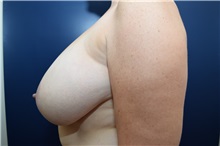 Breast Reduction Before Photo by Michael Dobryansky, MD, FACS; Garden City, NY - Case 38363