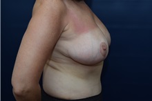 Breast Reduction After Photo by Michael Dobryansky, MD, FACS; Garden City, NY - Case 38363