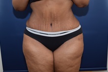 Tummy Tuck After Photo by Michael Dobryansky, MD, FACS; Garden City, NY - Case 38365