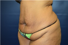 Tummy Tuck Before Photo by Michael Dobryansky, MD, FACS; Garden City, NY - Case 38365