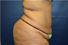 Tummy Tuck Before Photo by Michael Dobryansky, MD, FACS; Garden City, NY - Case 38365