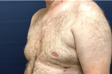 Male Breast Reduction After Photo by Michael Dobryansky, MD, FACS; Garden City, NY - Case 38367
