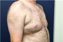 Male Breast Reduction After Photo by Michael Dobryansky, MD, FACS; Garden City, NY - Case 38367
