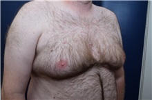 Male Breast Reduction Before Photo by Michael Dobryansky, MD, FACS; Garden City, NY - Case 38367