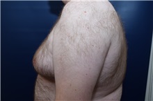 Male Breast Reduction Before Photo by Michael Dobryansky, MD, FACS; Garden City, NY - Case 38367