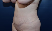 Tummy Tuck After Photo by Michael Dobryansky, MD, FACS; Garden City, NY - Case 38372