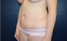 Tummy Tuck Before Photo by Michael Dobryansky, MD, FACS; Garden City, NY - Case 38372