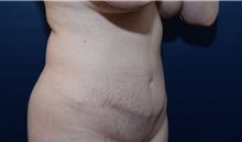 Tummy Tuck After Photo by Michael Dobryansky, MD, FACS; Garden City, NY - Case 38372