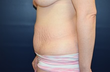 Tummy Tuck Before Photo by Michael Dobryansky, MD, FACS; Garden City, NY - Case 38372