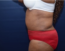 Tummy Tuck After Photo by Michael Dobryansky, MD, FACS; Garden City, NY - Case 38373