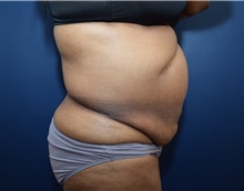 Tummy Tuck Before Photo by Michael Dobryansky, MD, FACS; Garden City, NY - Case 38373