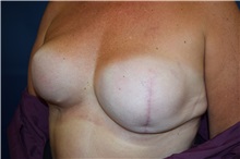 Breast Reconstruction Before Photo by Michael Dobryansky, MD, FACS; Garden City, NY - Case 38376