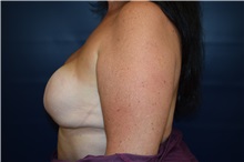 Breast Reconstruction Before Photo by Michael Dobryansky, MD, FACS; Garden City, NY - Case 38376