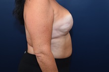 Breast Reconstruction After Photo by Michael Dobryansky, MD, FACS; Garden City, NY - Case 38376