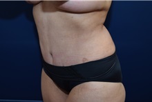 Tummy Tuck After Photo by Michael Dobryansky, MD, FACS; Garden City, NY - Case 38377