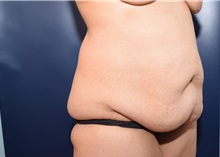 Tummy Tuck Before Photo by Michael Dobryansky, MD, FACS; Garden City, NY - Case 38377