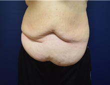Tummy Tuck Before Photo by Michael Dobryansky, MD, FACS; Garden City, NY - Case 38378