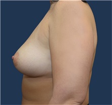 Breast Augmentation Before Photo by Michael Dobryansky, MD, FACS; Garden City, NY - Case 40836