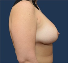 Breast Augmentation After Photo by Michael Dobryansky, MD, FACS; Garden City, NY - Case 40836