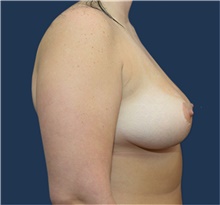 Breast Augmentation Before Photo by Michael Dobryansky, MD, FACS; Garden City, NY - Case 40836
