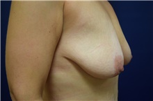 Breast Lift Before Photo by Michael Dobryansky, MD, FACS; Garden City, NY - Case 40840