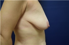 Breast Lift Before Photo by Michael Dobryansky, MD, FACS; Garden City, NY - Case 40840