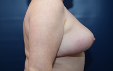 Breast Lift After Photo by Michael Dobryansky, MD, FACS; Garden City, NY - Case 40841